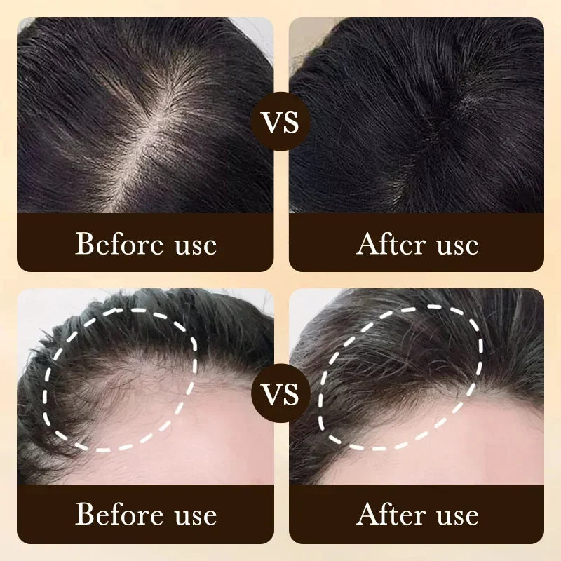 비오틴 빠른 모발 성장 오일 제품 케어 두피 마사지 트 - Beard Oil Growth 리뷰 및 가격