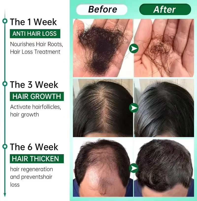 헤어 성장 세럼 7일 빠른 재성장 에센셜 캡슐 탈모 방 - Ingrown Hair Serum 리뷰 및 가격